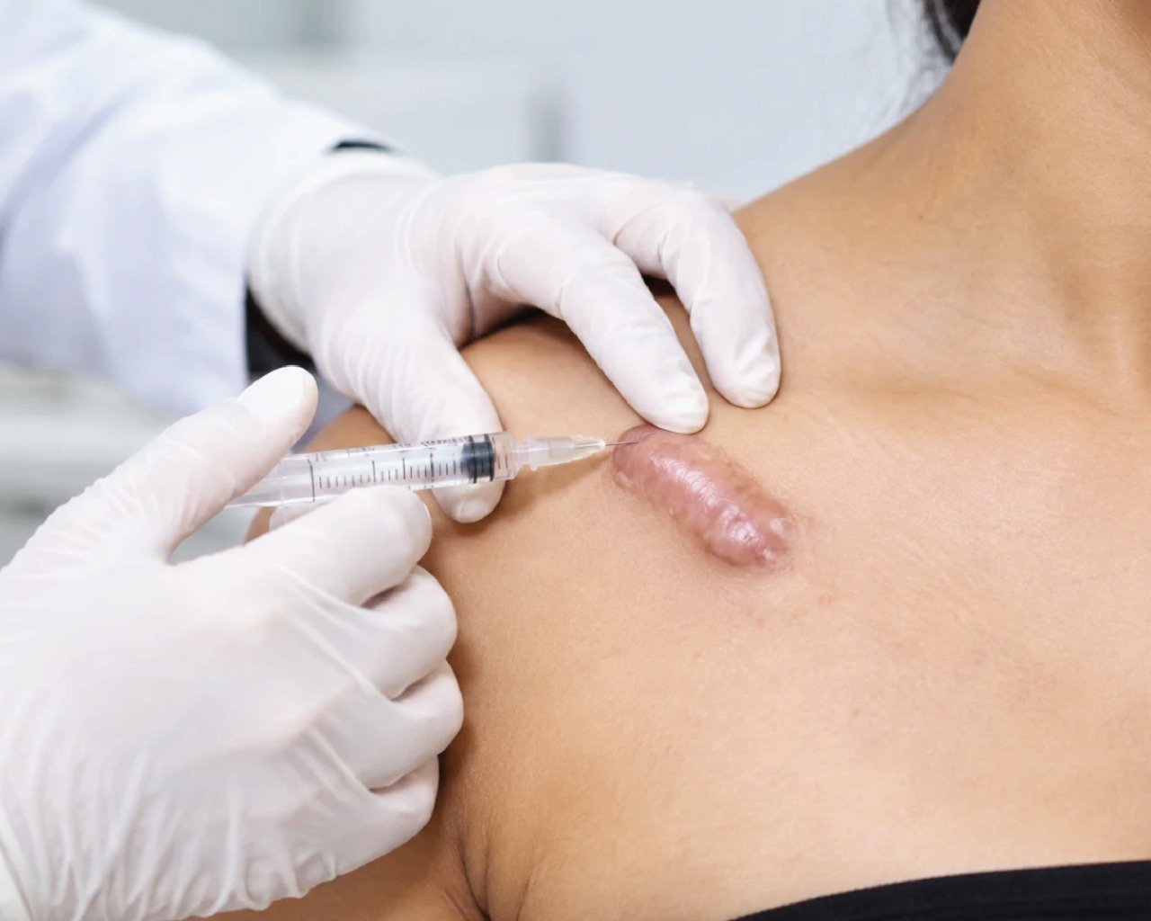 Keloid Injection