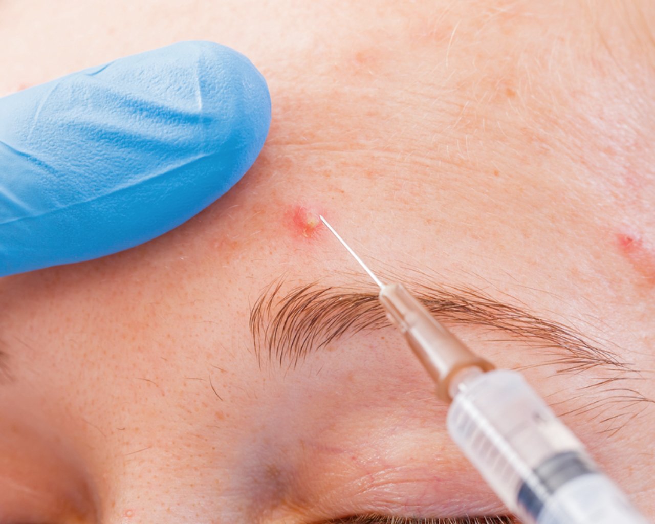 Acne Injection
