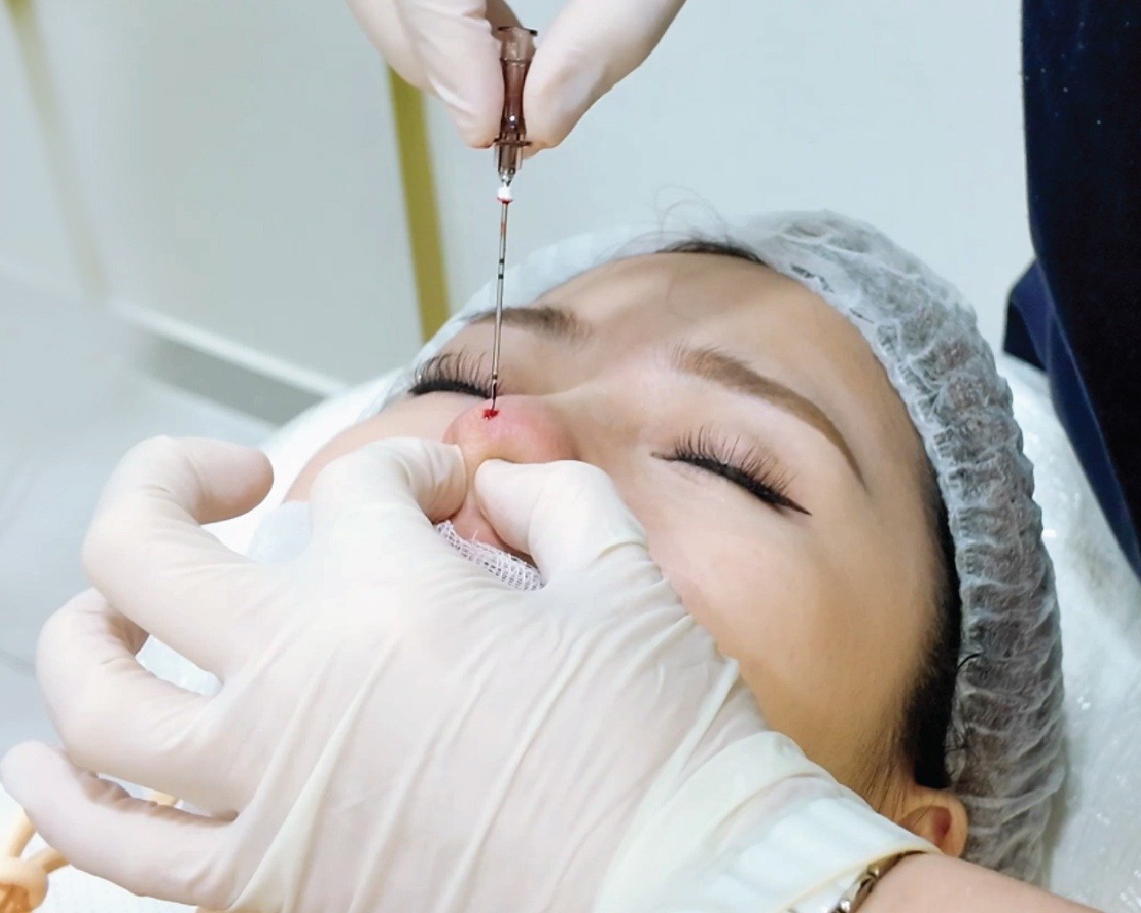 L-Shape Nose Lift